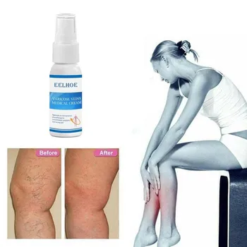 Krčnih Veno Pomirja Spray Vaskulitis Zdravljenje Tekočine Na Noge Kisline Bilges Srbenje Zemlji Črv Kosih Noge Zdravilo Naravnih Rešitev